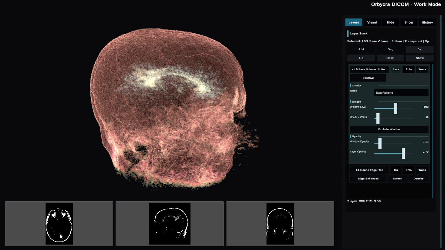 Orbycra DICOM Viewer desktop workspace showing an interactive volumetric rendering, three orthographic slice views, and the active Layers controls.