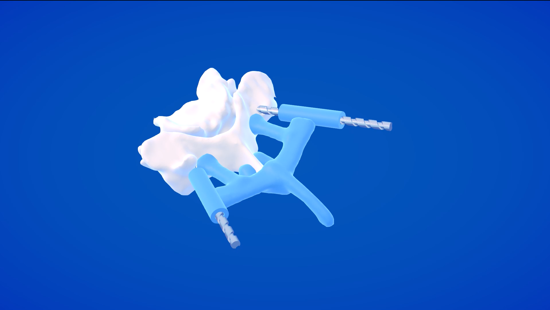 A blue patient-specific pedicle screw guide fitted to a reconstructed vertebra model.